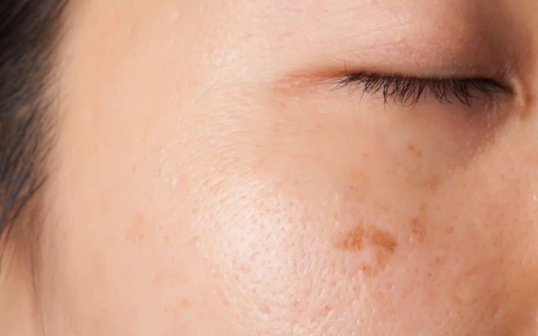 What Causes Brown Spots on the Skin?