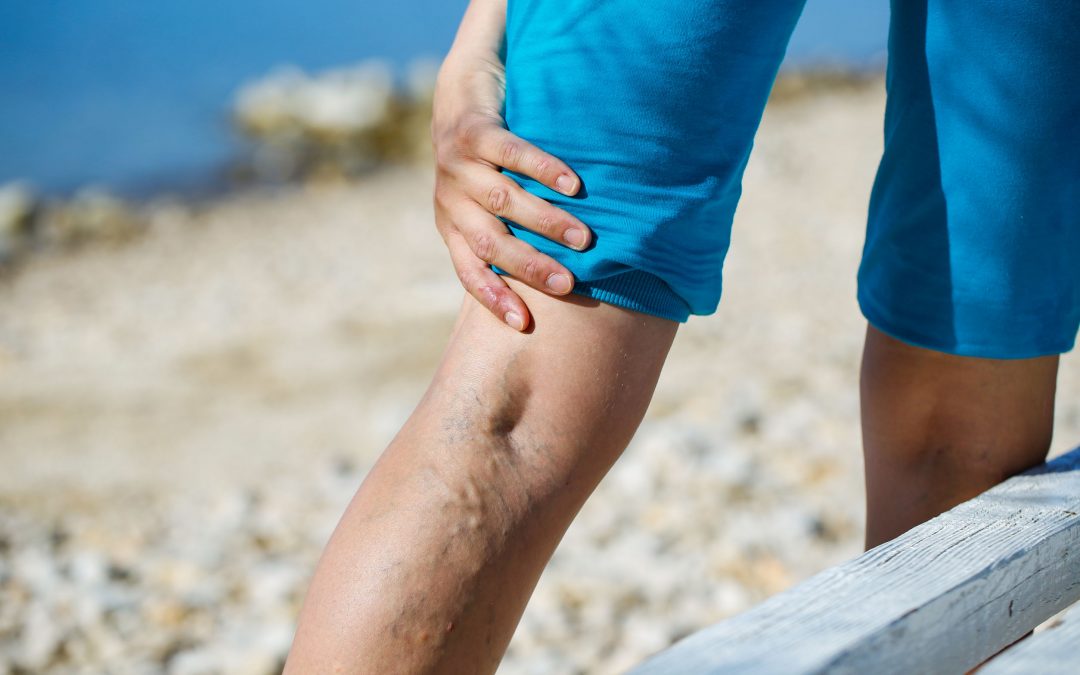 What Are Varicose Veins?