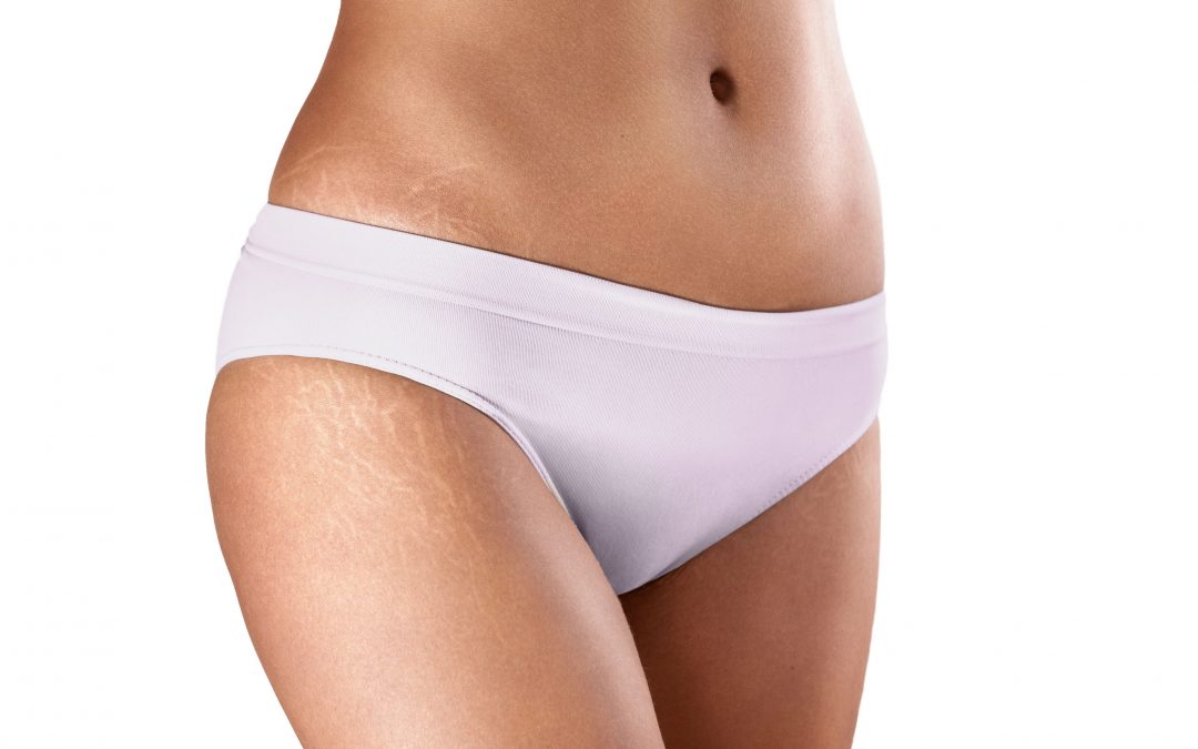 Stretch Marks – How They Develop and Who Gets Them