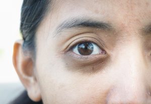 dry skin around eyes | Beverly Hills MD